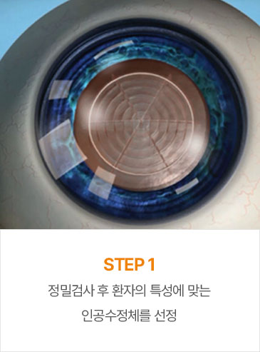 STEP1 정밀검사 후 환자의 특성에 맞는인공수정체를 선정