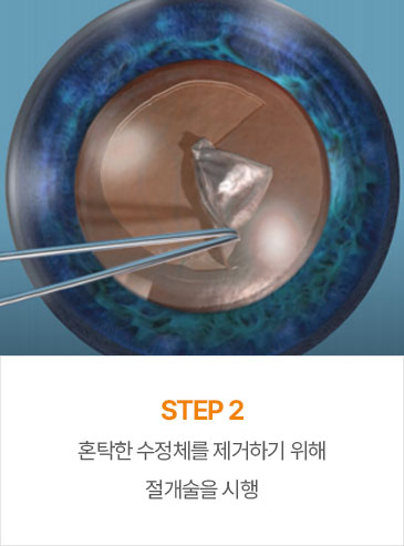 STEP2 정밀검사 후 환자의 특성에 맞는인공수정체를 선정