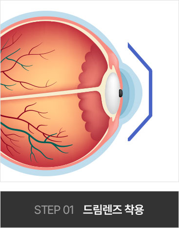 STEP1 드림렌즈 착용