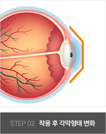 STEP2 착용 후 각막형태 변화