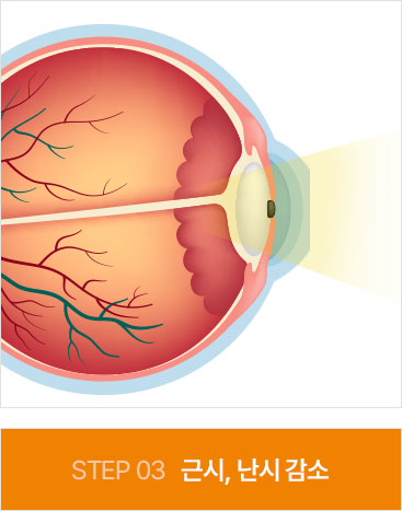 STEP3 근시, 난시 감소